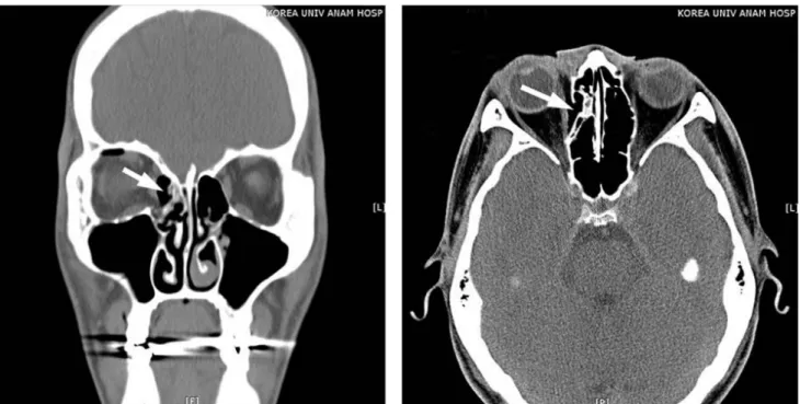 Fig. 1. A computerized tomography scan was performed before surgery and showed a medial orbital wall fracture (arrow)