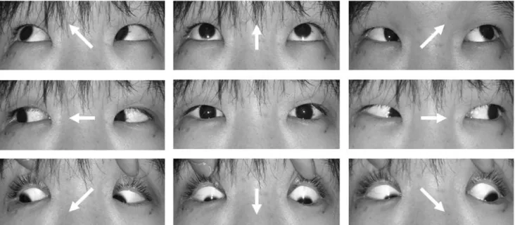 Fig. 4. Fundus examination showed intorsion of the right eye. 