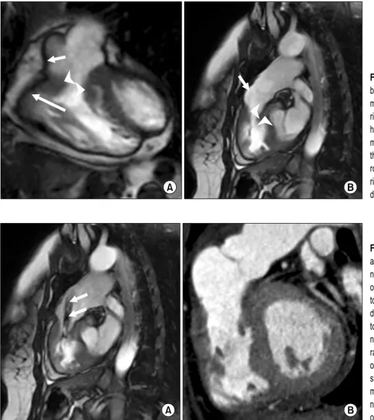 Fig. 1. (A) Coronal and (B) sagittal  balanced steady-state free-precision  magnetic resonance images of the  right ventricular outflow tract of the  heart during diastole show thickened  muscular bands (arrowheads) between the thin-walled infundibulum (sh