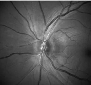 Fig. 5. Visual field test of the left eye with a Humphrey perimeter  on postoperative day 1.