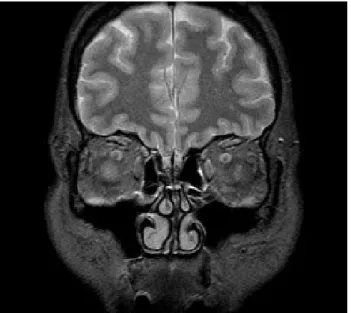 Fig. 8. MRI image of the brain and orbit on postoperative day 10  showing only age-related changes.