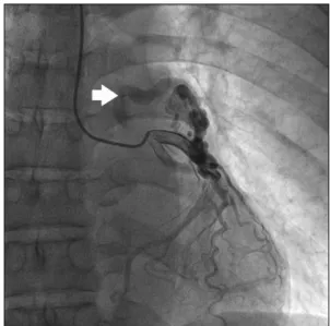 Fig. 1. Coronary angiography. Left coronary angiography demon- demon-strated an anomalous coronary fistula from the proximal left  ante-rior descending coronary artery to the main pulmonary artery  (arrow).