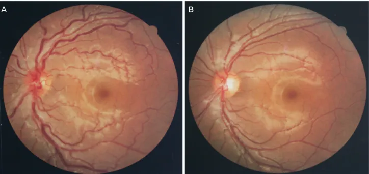 Fig. 1. Case 3. (A) Fundus findings of slightly tortuous and engorged retinal veins at first visit
