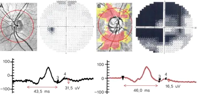 Fig. 3. The photopic negative response (PhNR) waves from the normal (A) and primary open angle glaucoma (POAG) groups (B)