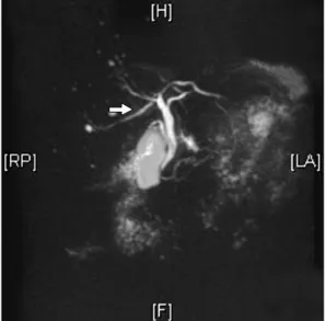 Fig.  6.  Variation  of  bile  duct;  Right  posterior  duct  (arrow)  meets  left  hepatic  duct  and  drains  into  common  hepatic  duct.