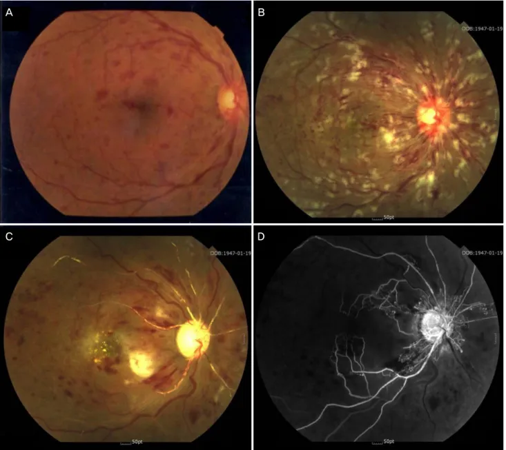 Fig. 1. The right eye at presentation and at two- and 11-weeks post-presentation. (A) Dilated and tortuous retinal veins, some intraretinal hem- hem-orrhages at the posterior pole, and a slightly swollen optic disc were found in the right eye at presentati