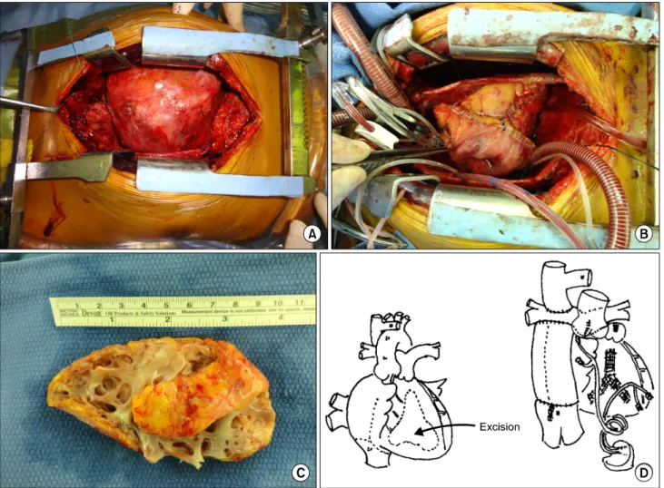 Fig. 1. Preoperative and postoperative heart appearance. (A) The markedly dilated RV is shown