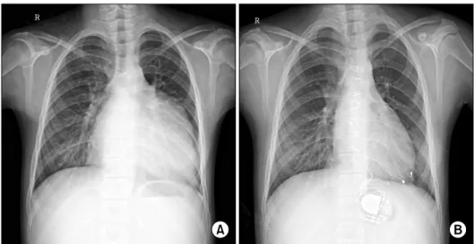 Fig. 3. Preoperative and postoperative 1-year chest X-ray. (A) Severe  car-diomegaly is shown