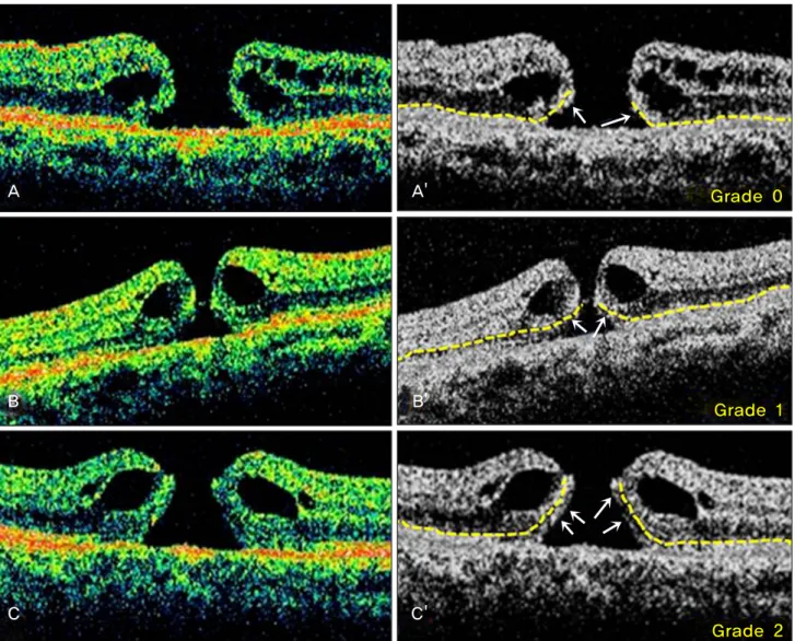 Fig. 2. Exemplary cases utilized for the grading of viability in detached photoreceptors (parameter D)