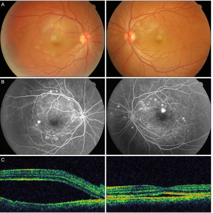 Fig. 1. (A) Fundus photographs of the right eye (left) and left eye (right) showing bilateral serous retinal detachment in the macula at  the initial visit