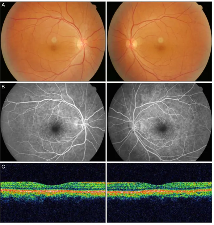 Fig. 2. (A) Fundus photographs of the right eye (left) and left eye (right) showing complete resolution of bilateral serous retinal  detachment one month after systemic chemotherapy