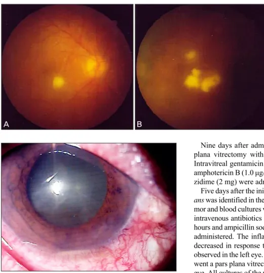 Fig. 1. (A) Right eye. Exudate was  round, whitish-yellow, and slightly  elevated towards the vitreous cavity