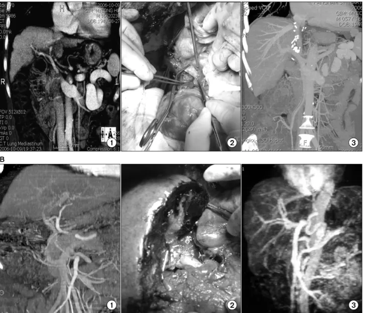 Fig.  1.  Various  reconstructive  methods  to  the  thrombosed  portal  veins  of  recipients  in  case  eversion  thrombectomy  couldn’t  be  possible