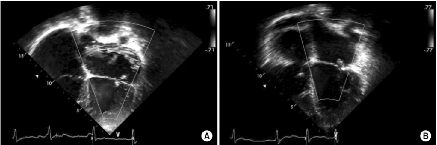 Fig. 3. (A) Preoperative transthoracic echocardiography showing moderate to severe mitral regurgitation