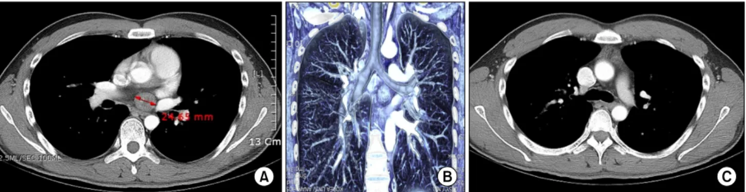 Fig. 1. (A) Constrast enhanced chest computed tomography (CT) and (B) three dimensional CT reconstruction showing the well-demarcated  margin of the mass and its location between the posterior wall of the left atrium, right pulmonary artery, and the carina