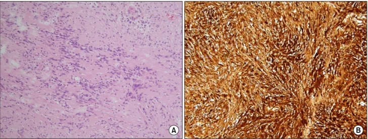 Fig. 3. Histopathologic findings. (A) The spindle cells show palisading arrangement (H&amp;E, ×100)