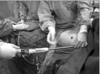 Fig. 2. Endoscopic vein harvesting device with an instruments  channel, a carbon dioxide insufflator channel, an endoscope, and  a lens cleaning system, as an example of an integrated  instru-ment design for single-port video-assisted thoracic surgery surg