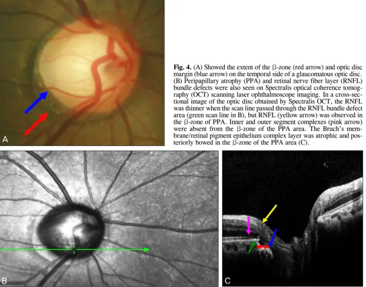 Fig. 4. (A) Showed the extent of the β-zone (red arrow) and optic disc  margin (blue arrow) on the temporal side of a glaucomatous optic disc