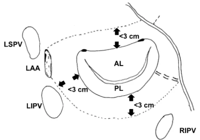 Fig. 1. The Cox maze procedure. Epicardial view of the atria  and endocardial view of the right atrium