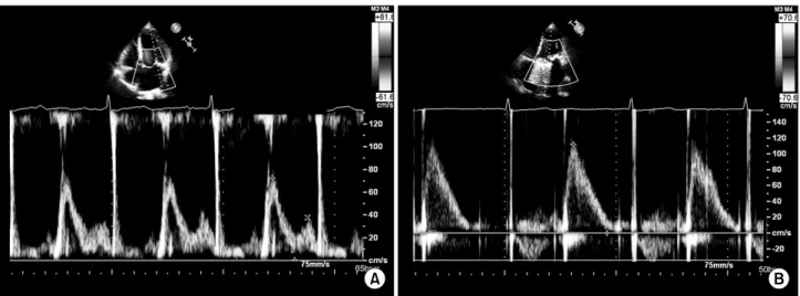 Fig. 3. Sample echocardiographic examinations of two patients after the Cox maze procedure