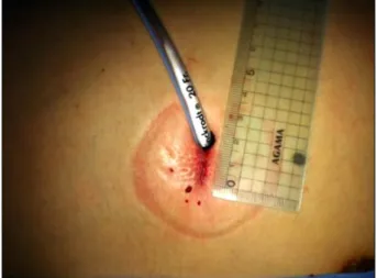 Fig. 1. Surgical wound after single-port video-assisted thoracic  surgery for primary spontaneous pneumothorax.