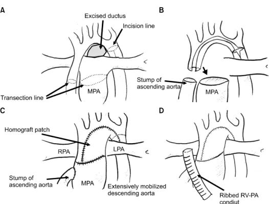 Fig. 2. Schema of the operation. (A) The left lateral side of the aortic arch is incised beginning at the divided aortic isthmus and extend- extend-ing proximally down to the transected ascendextend-ing aorta