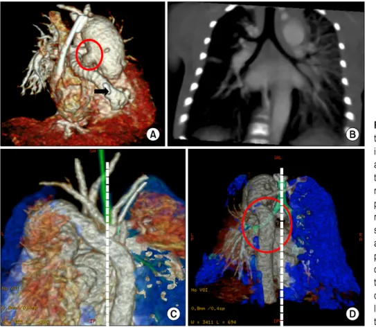 Fig. 3. Postoperative chest compu- compu-ted tomography findings and changes  in the location of the descending  aorta