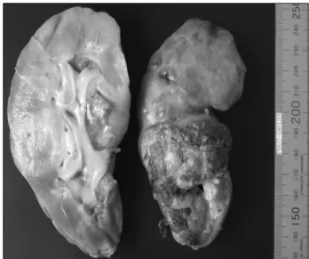 Fig.  1.  Abdominopelvic  CT  shows  perirenal  hematoma  or  abscess  with  parenchymal  defect  of  transplanted  kidney.
