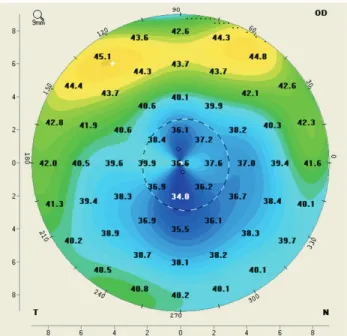 Fig. 1. Screen-map shot of the true net power map of the Pentacam  system. The exact central K-value in the true net power map was  used in this study.