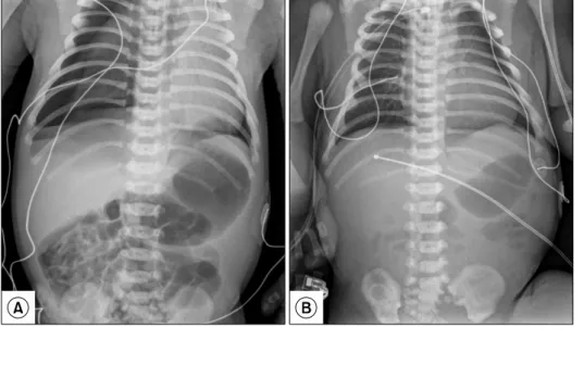 Fig. 1. (A) Initial infantogram show- show-ing a right pneumothorax. (B)  Infan-togram after closed thoracostomy.