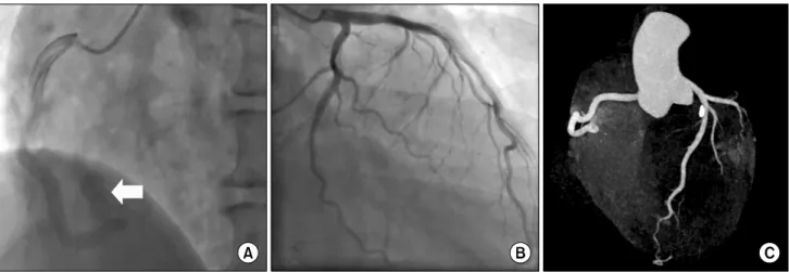 Fig. 1. Initial electrocardiogram showed ST elevations in leads II,  III, and aVF.