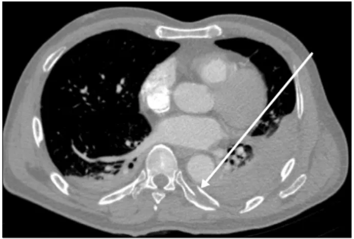 Fig. 2. Follow-up chest computed tomography, 4-post trauma day. 