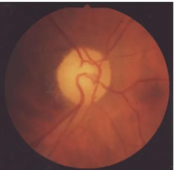 Fig. 3. Visual field plotted by Goldmann perimeter at the time of  diagnosis. A diffuse cecocentral scotoma was observed.