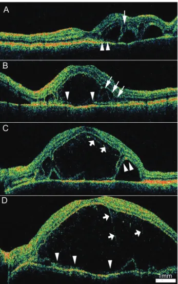 Fig. 1. Cross-sectional images taken using high resolution optical  coherence tomography (OCT) show the various features of the  cys-toid space in acute Vogt-Koyanagi-Harada disease