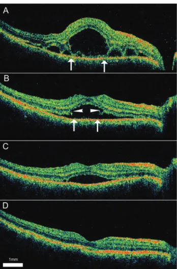Fig. 4. Serial 9 mm vertical optical coherence tomography (OCT)  scans from the right eye of a 43-year-old woman diagnosed with  Vogt-Koyanagi-Harada disease