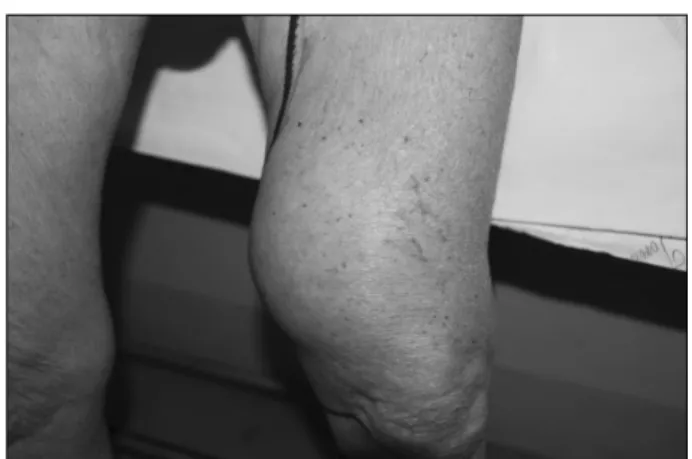 Fig. 1. Voluminous pulsating mass in distal portion of left thigh.