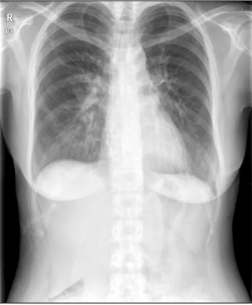 Fig. 2. Chest X-ray at the time of last follow-up.