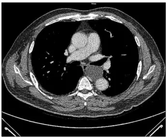 Fig. 1. Case 1. Chest computed tomography shows 4-cm sized  mediastinal cystic mass adjacent to left side of the esophagus