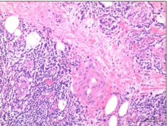 Fig. 6. Case 2. Lymphatic epithelial cells are stained with CD31  antibody (immunohistochemistry with CD31, ×200).