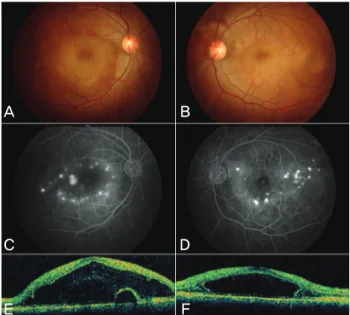 Fig. 1. Fundus photography, fluorescein angiography (FAG) and  optical coherence tomography (OCT) performed at the initial visit