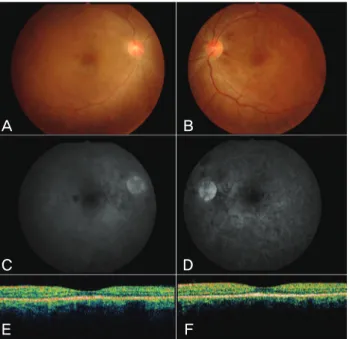 Fig. 2. Fluorescein angiography (FAG) and indocyanine green an- an-giography (ICG) performed after 1 week of close observation using  5 mg predisolone under the impression of steroid induced central  se-rous retinopathy