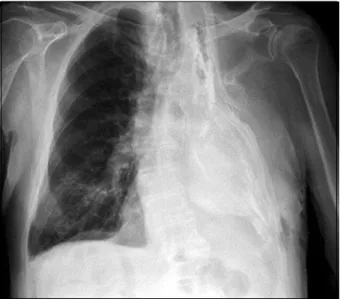 Fig. 4. Post-thoracoplasty chest X-ray.