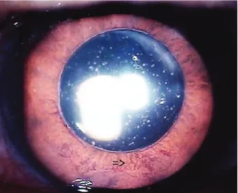 Fig. 1. Slit lamp examination demonstrated 6 clock hours of angle  neovascularization with synechiae in the left eye.