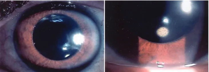 Fig. 3. One day after intravitreal injection of bevacizumab, neovascularization of the iris had almost completely resolved.