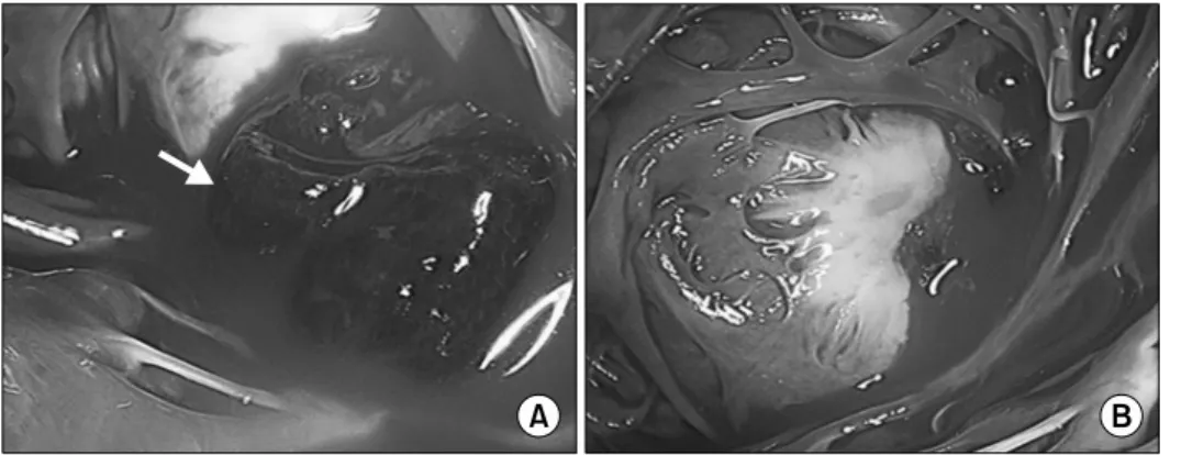 Fig. 1. Preoperative echocardiography finding: hypoechogenic, mo- mo-bile thrombus was observed (arrows).