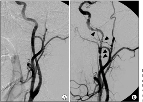 Fig. 3. Carotid angiogram showing  the vascular spasm. (A) Before a  stent insertion. (B) Spasm  (arrow-heads) along the distal segment  de-veloped shortly after the stent  in-sertion necessitated an additional  stent placement.