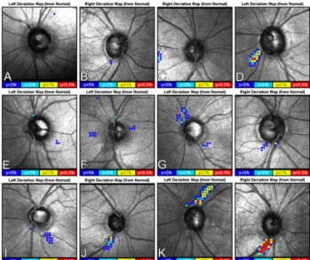 Fig. 2. Photographs showing diffuse retinal nerve fiber layer (RNFL)  defects detected in the same eye