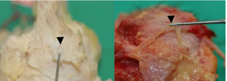 Fig. 3. Photographs showing weak, string-shaped Whitnall’s ligaments (arrowhead).