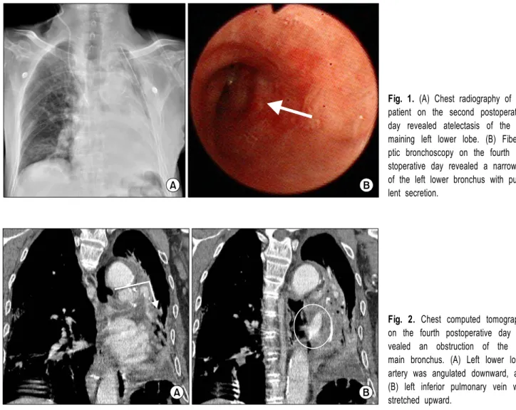 Fig. 1. (A) Chest radiography of the  patient on the second postoperative  day revealed atelectasis of the  re-maining left lower lobe
