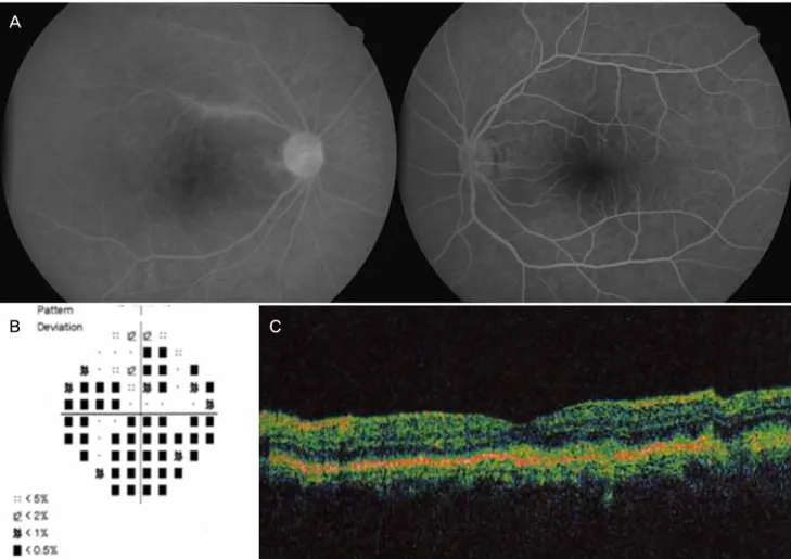 Fig. 1. (A) Fluorescein angiography; some perivascular dye leakage, disc hyperfluorescence and granular patterns of scattered hypofluorescent  and hyperfluorescent spots are seen in the right eye